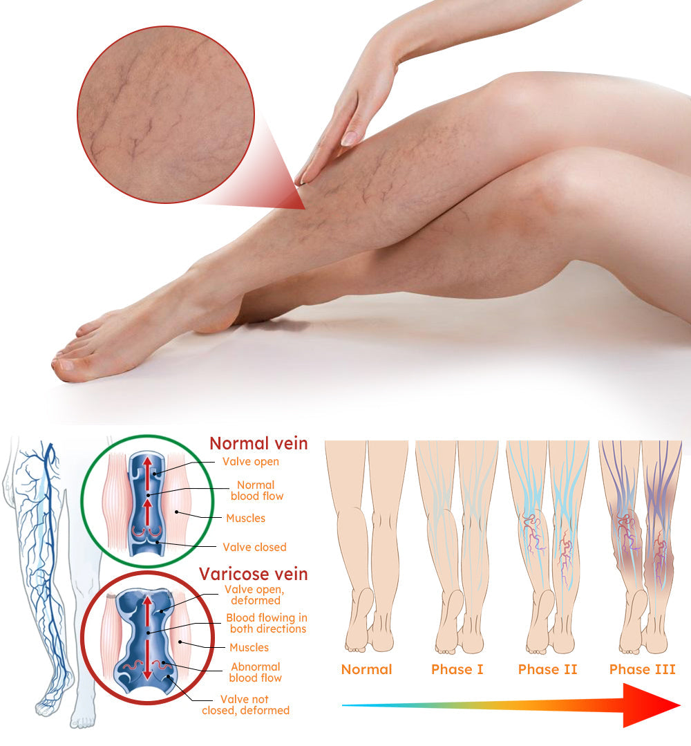 Furzero™  Turmeric Varicose Vein Patch