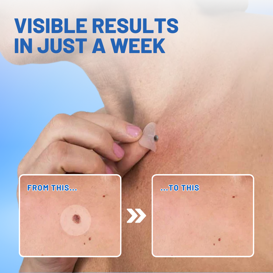 LOVILDS™ Moles & Warts Removing Skin Tag Patch