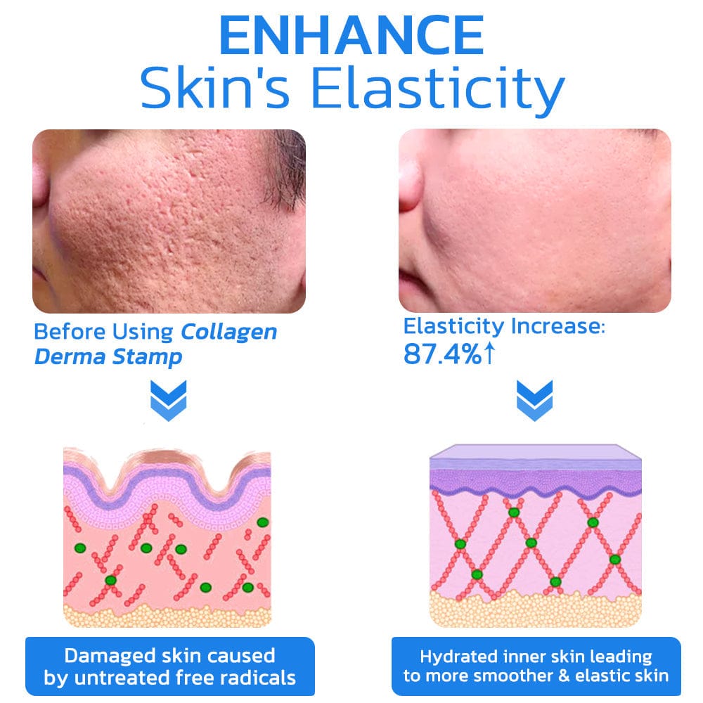 Flysmus™ PockmarksNeedling Collagen Derma Stamp