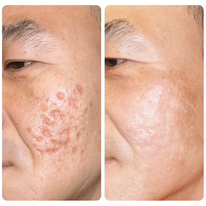 Flysmus™ PockmarksNeedling Collagen Derma Stamp