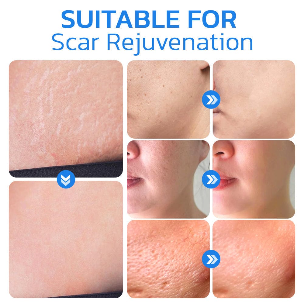 Flysmus™ PockmarksNeedling Collagen Derma Stamp