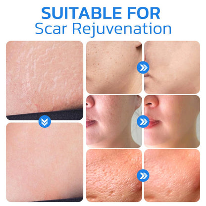 Flysmus™ PockmarksNeedling Collagen Derma Stamp