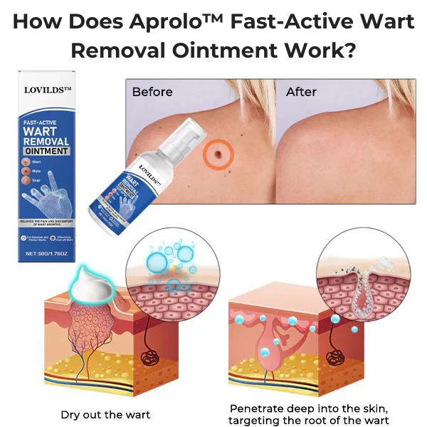 Aprolo™ Fast-Active Wart Removal Ointment