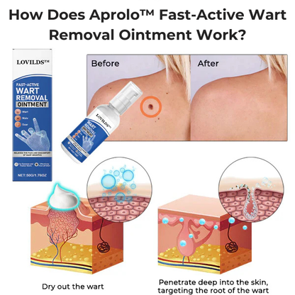 Aprolo™ Fast-Active Wart Removal Ointment