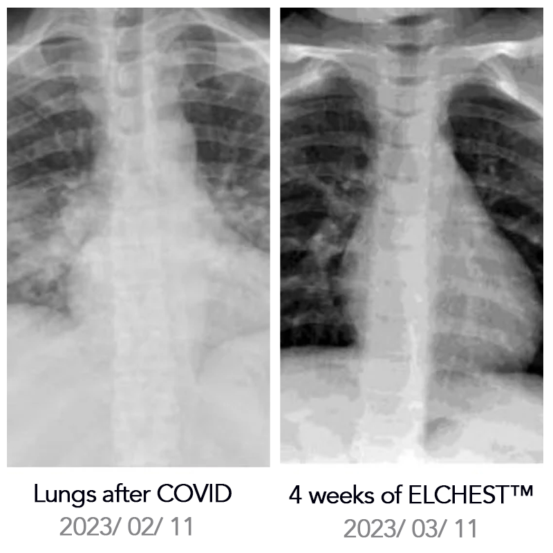 ELCHEST™ Herbal Lung Cleanse Repair Nasal Spray