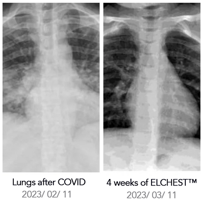 ELCHEST™ Herbal Lung Cleanse Repair Nasal Spray
