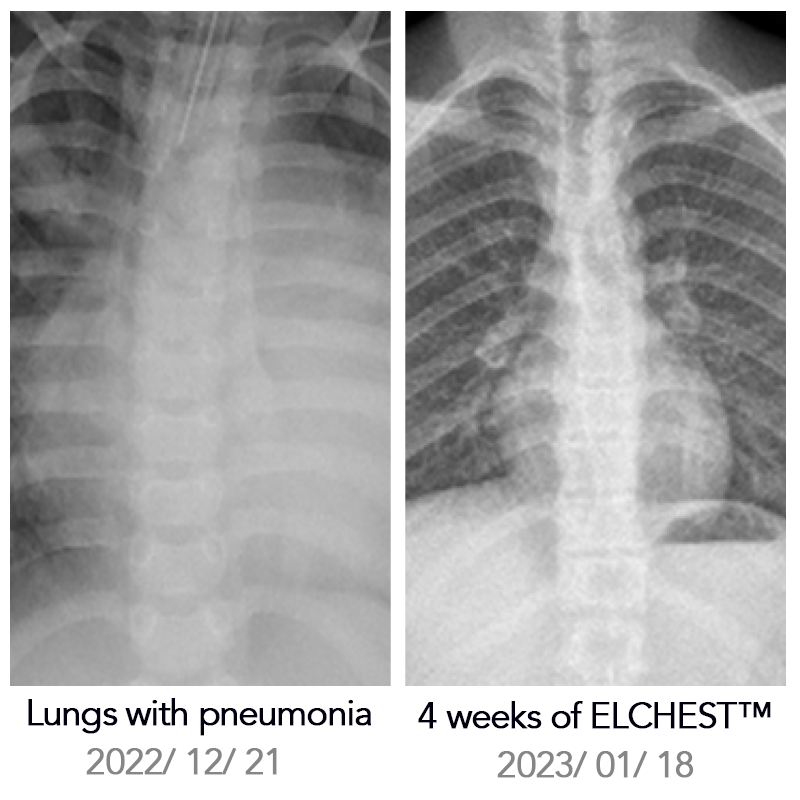 ELCHEST™ Herbal Lung Cleanse Repair Nasal Spray