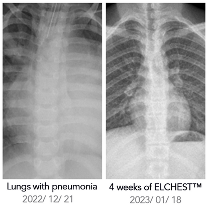 ELCHEST™ Herbal Lung Cleanse Repair Nasal Spray