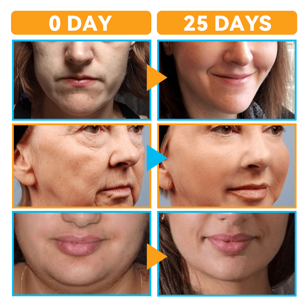 GFOUK™ HIFU Face Lifting Instrument
