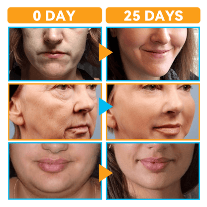GFOUK™ HIFU Face Lifting Instrument