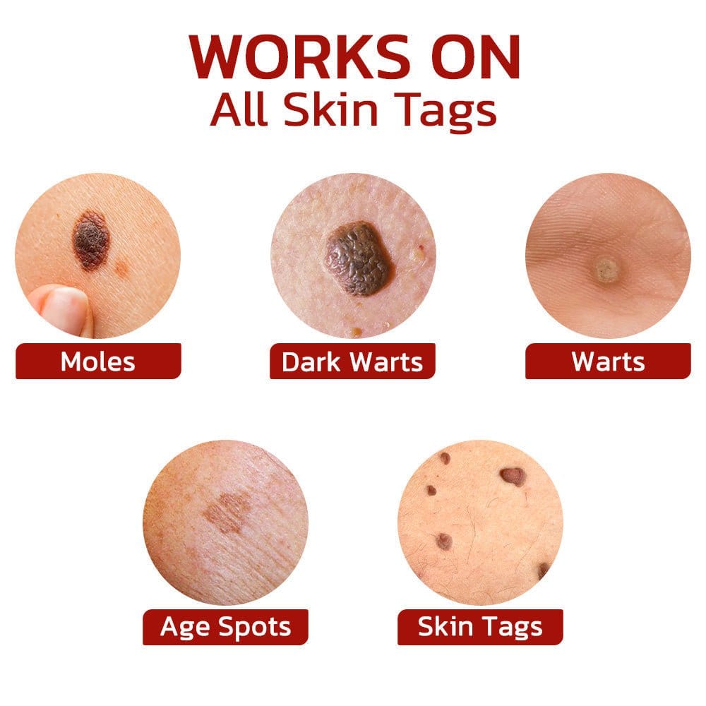 Aprolo™ WipeOff Tags And Moles Remover