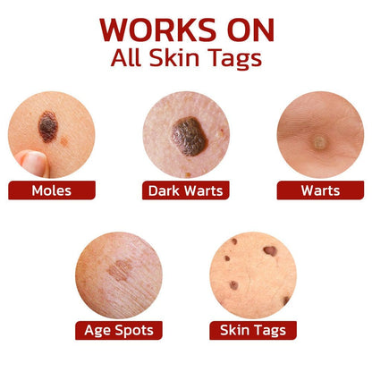 Aprolo™ WipeOff Tags And Moles Remover