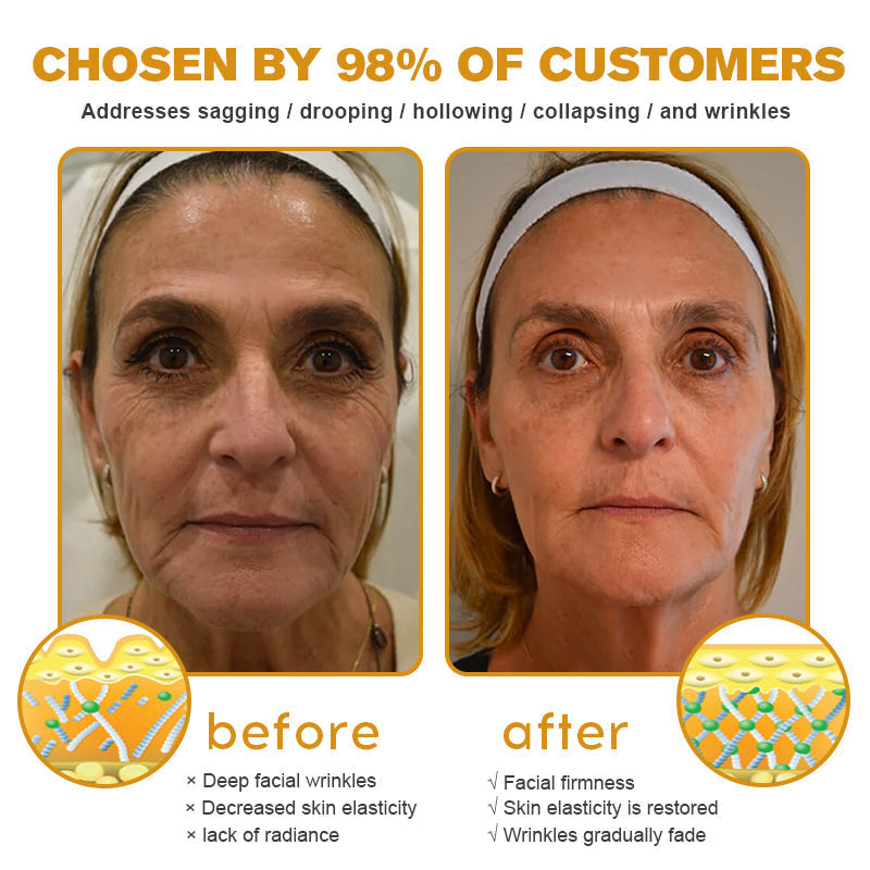 TLOPA® Botox Bee Venom Wrinkle Removal Cream